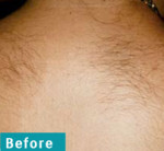 Laser Hair Removal – Before and After Photos