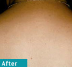 Laser Hair Removal – Before and After Photos
