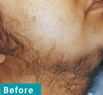 Laser Hair Removal – Before and After Photos