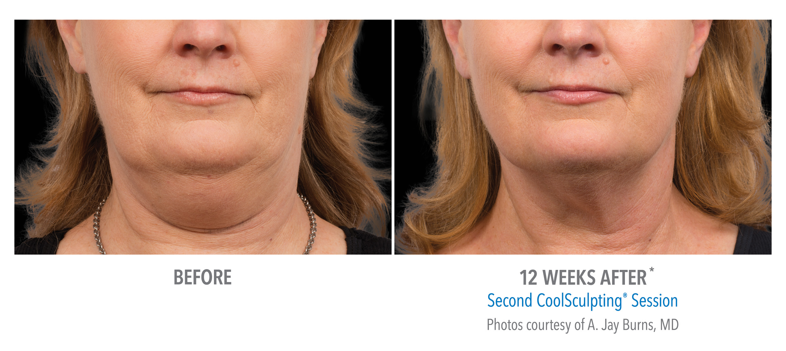 Before and after CoolSculpting chin treatment