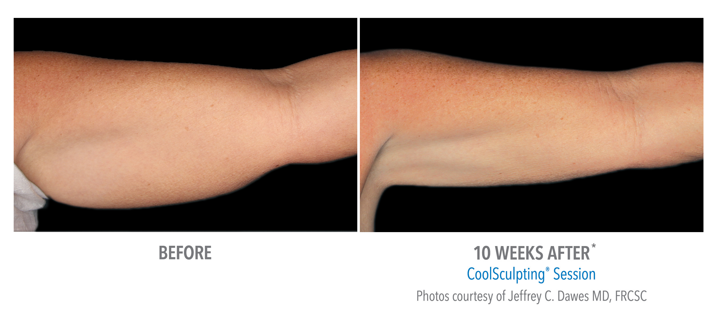 Before and after CoolSculpting arm fat reduction