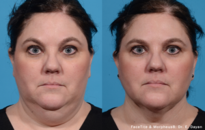 FaceTite, Morpheus8 Results Kearney