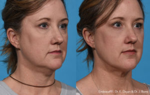 FaceTite, Morpheus8 Results Kearney