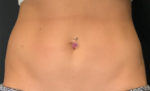 CoolSculpting – Before and After Photos