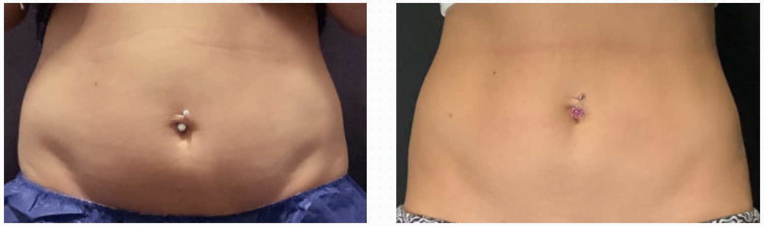 Before and after CoolSculpting abdominal treatment
